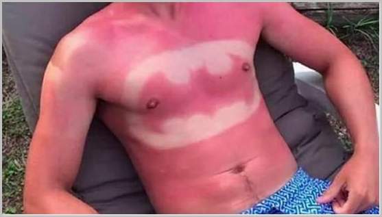 sunburn-man